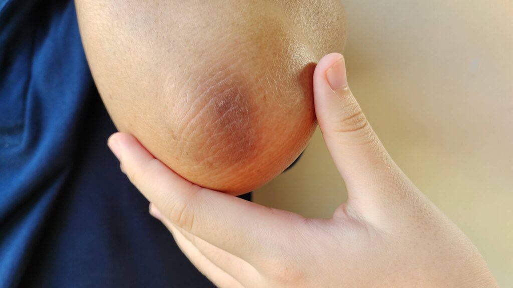 Close-up of a very dry, cracked elbow being held for inspection.