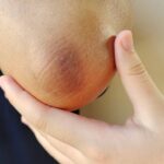 Close-up of a very dry, cracked elbow being held for inspection.